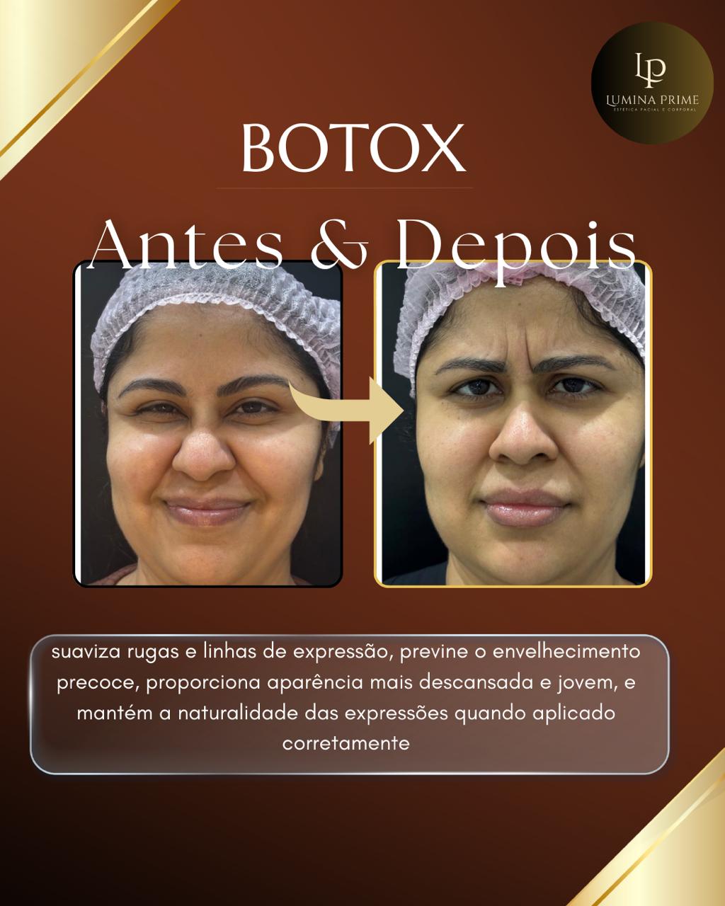 Botox