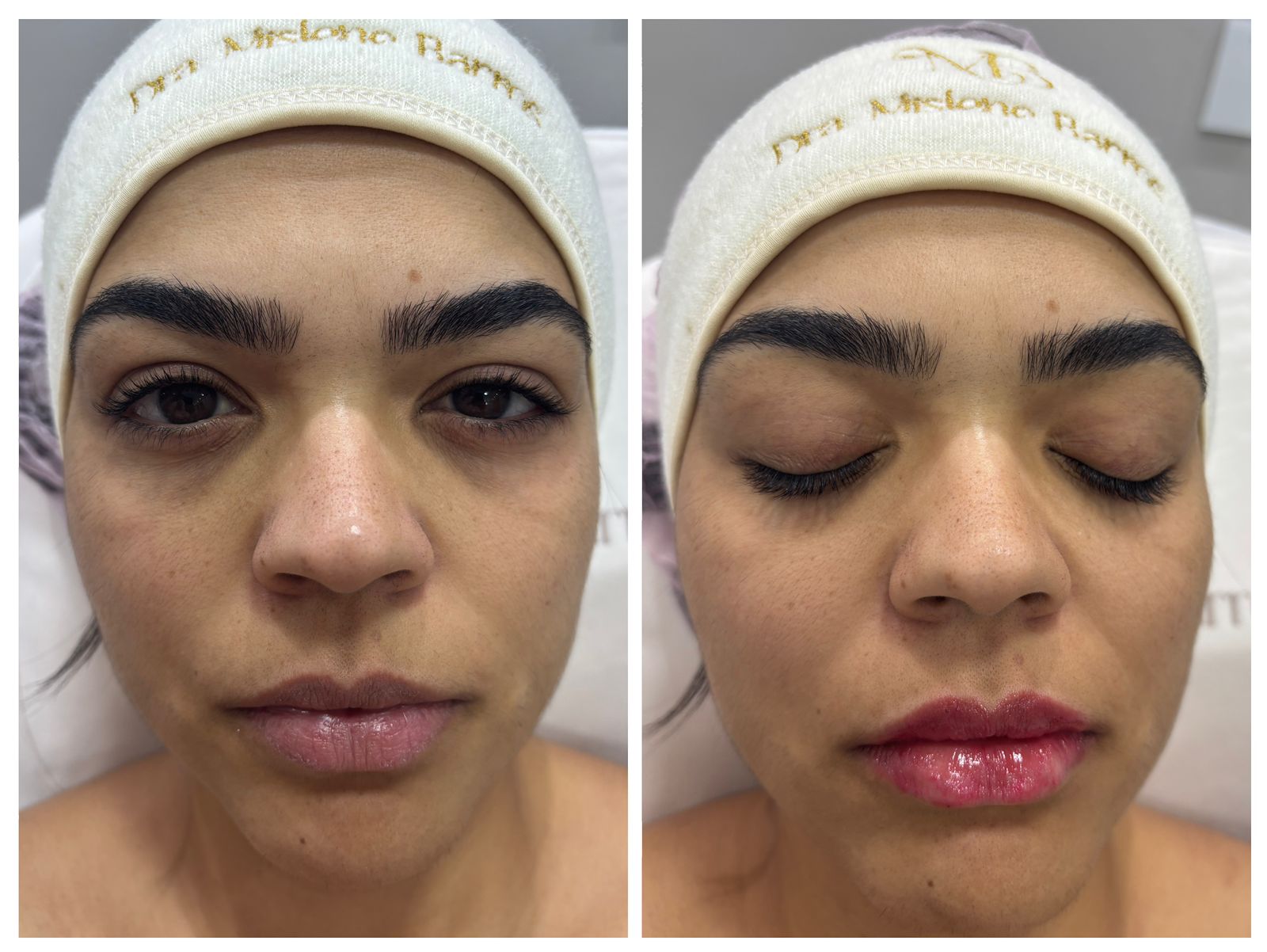 Harmonização facial natural
